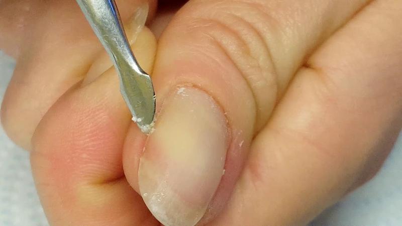 Czy zwalczać skórki przy paznokciach? Oto, co powinieneś wiedzieć